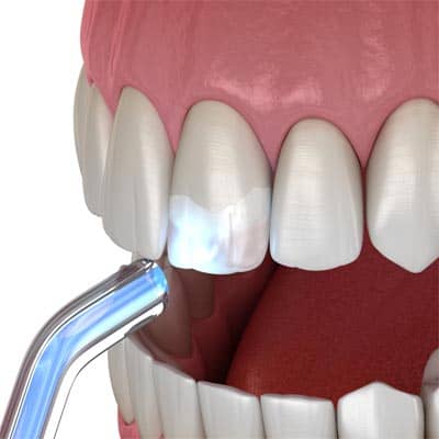 Dental Veneers as Composite Resin