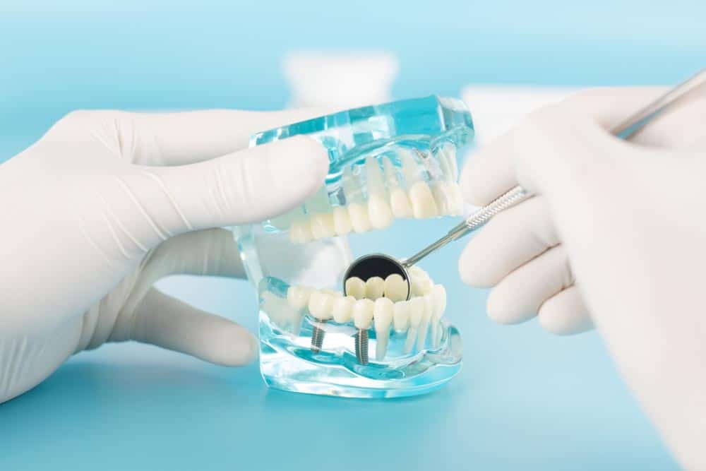 cost of veneers