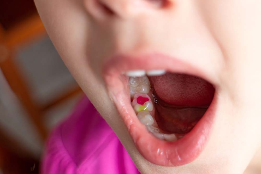 Tooth Colored Fillings