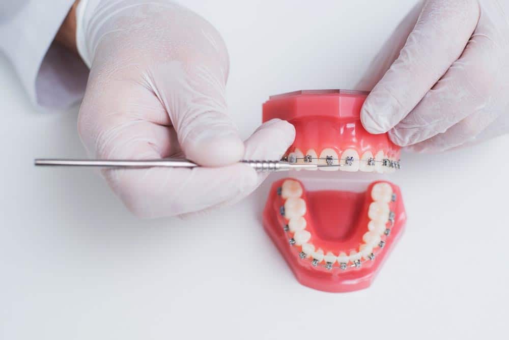 cost of veneers