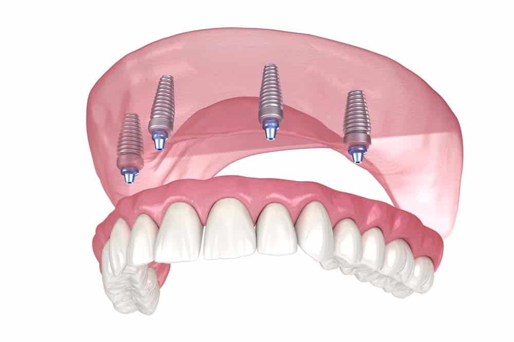 all-on-4-dental-implants-department