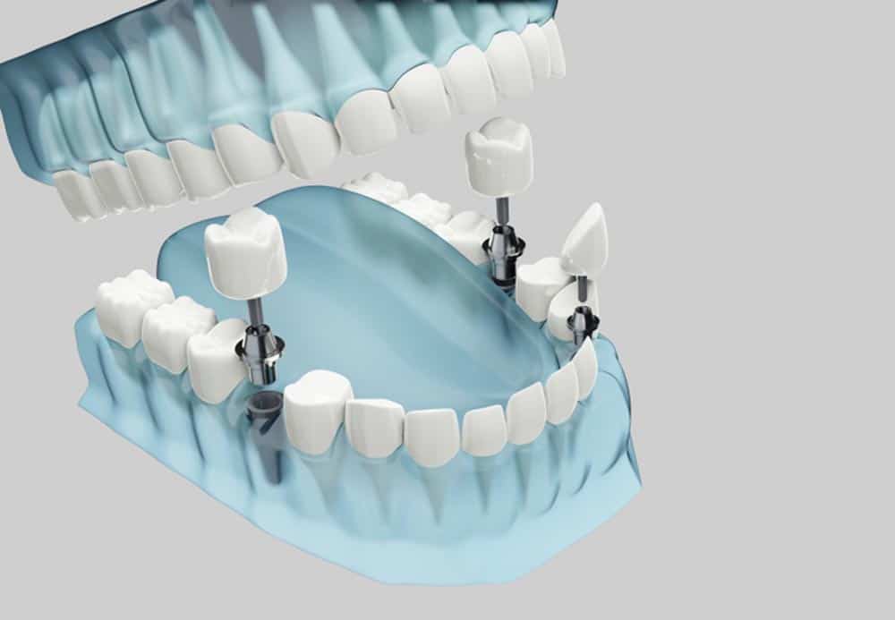 cost of veneers