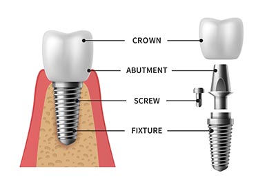 Abutment of dental implants