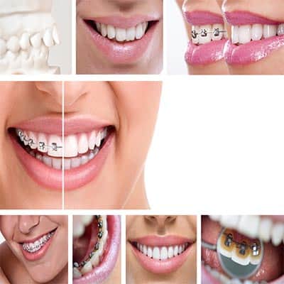 Are Lingual Braces more comfortable than Braces