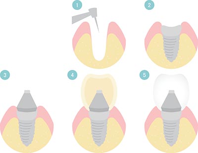 The Whole Process of dental implants