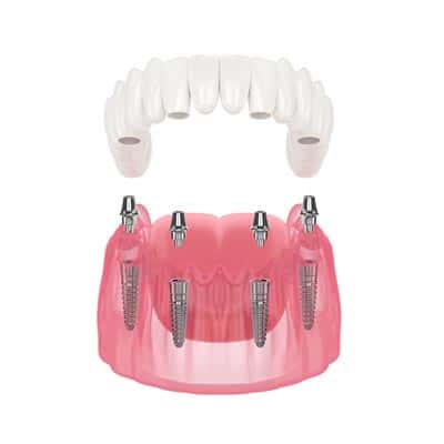 What are the Advantages of All in 4 Implants