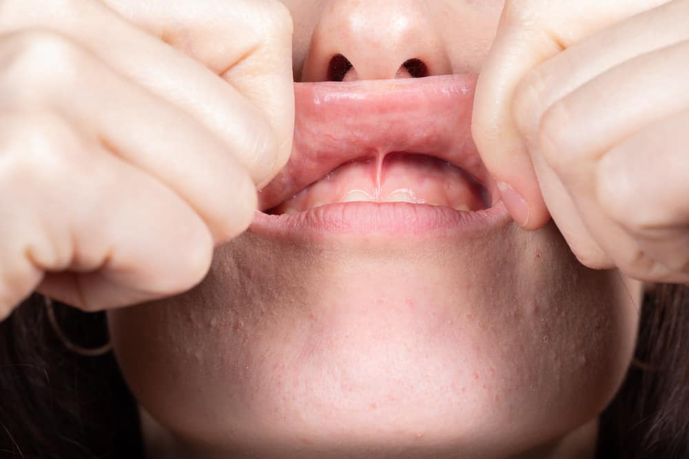 cost of veneers