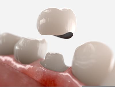 Can I get a tooth cap