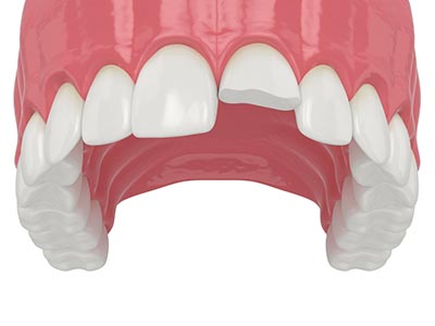 Chipped teeth crowns