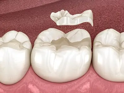 Porcelain Fillings