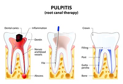 Pulp removal root canal treatment