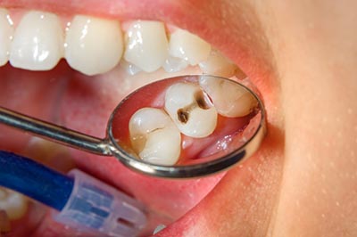 What are the Disadvantages of Composite Fillings?