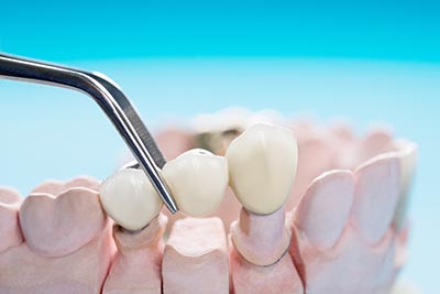 dental crowns procedure