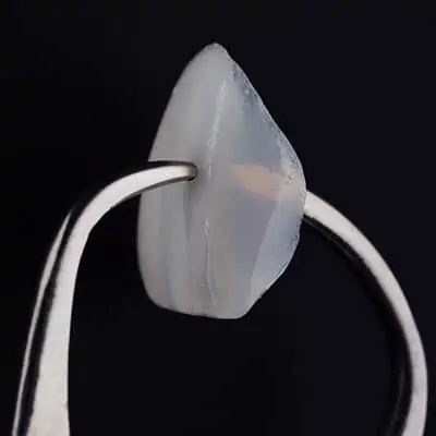 dental veneers