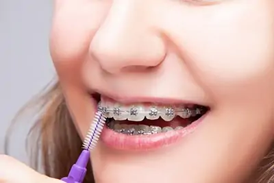 metal braces aftercare