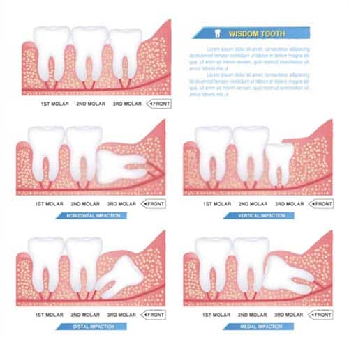 Are there any Risks Involved with Wisdom Teeth