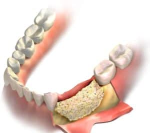Bone Graft For Dental Implants