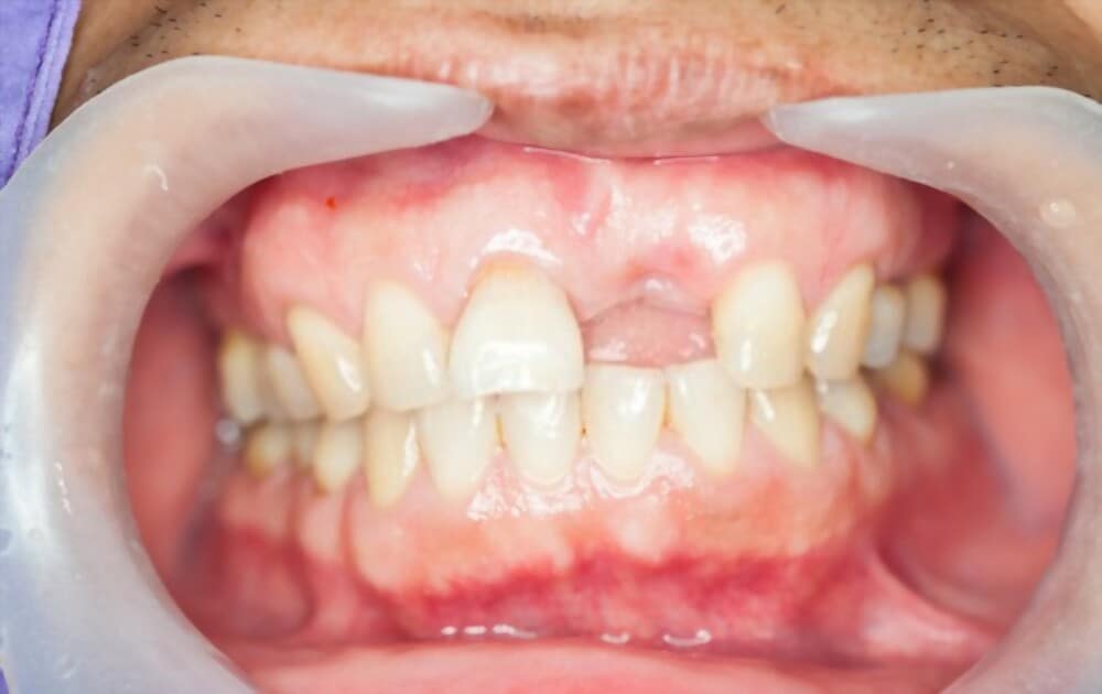 Bone grafting department