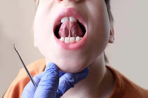 Buccal Frenectomy