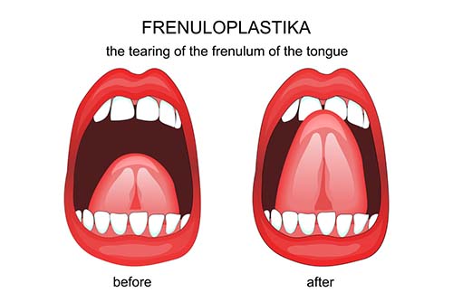 Frenectomy for Adults