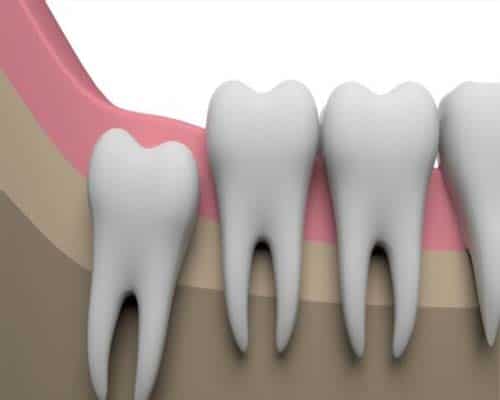 How do you Know when Your Impacted Wisdom Teeth are Coming Out
