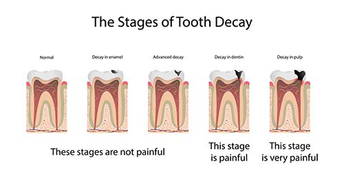 The Different Stages of Tooth Decay