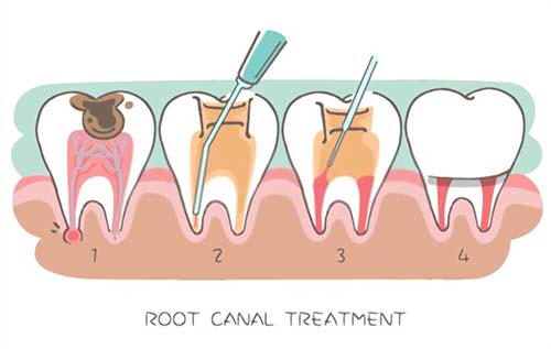 The Root Canal Procedure