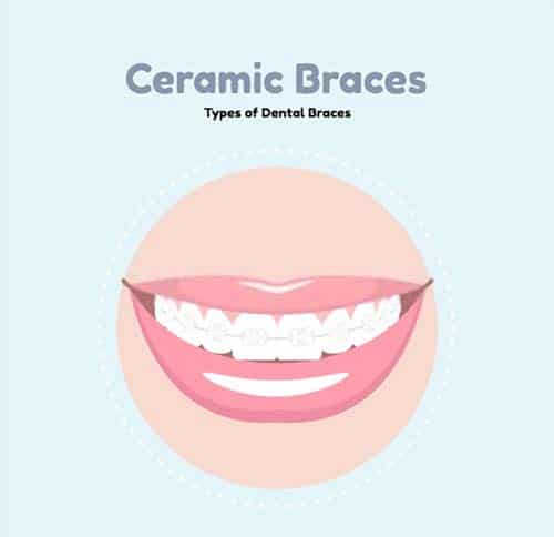 Advantages of Ceramic Braces