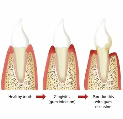 Causes of Periodontitis