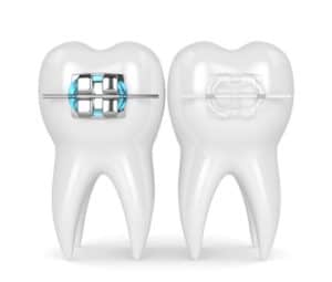 Clear VS. Metal Braces
