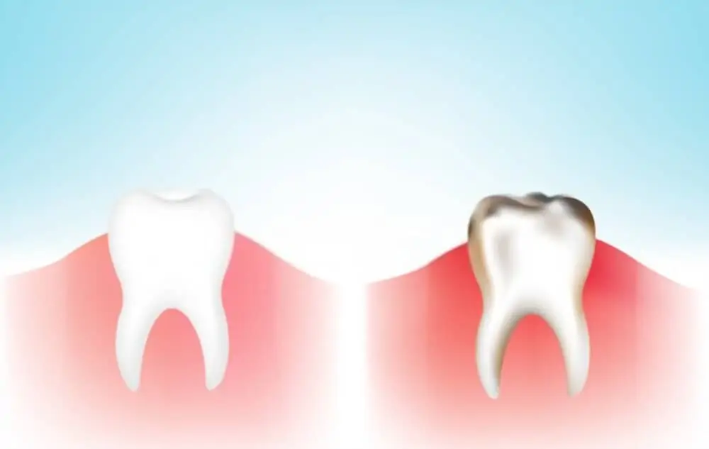 Gingivitis VS. Periodontitis 2
