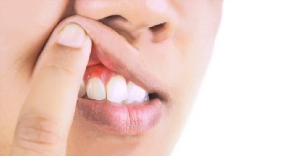 How to Get Rid of Gingivitis