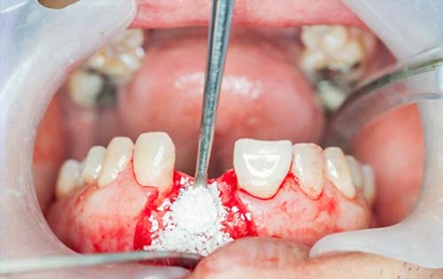 Reasons for Bone Grafting