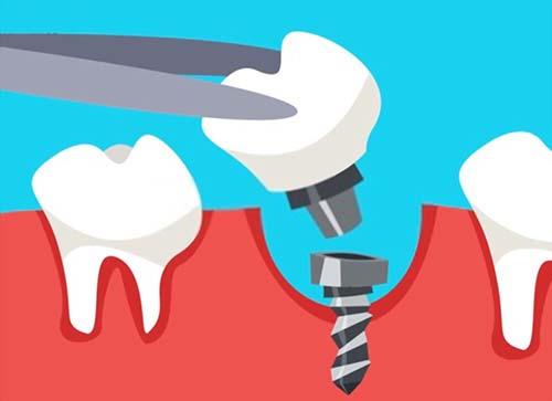 Risks Associated with Dental Implants