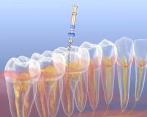 Root Canal On Molars