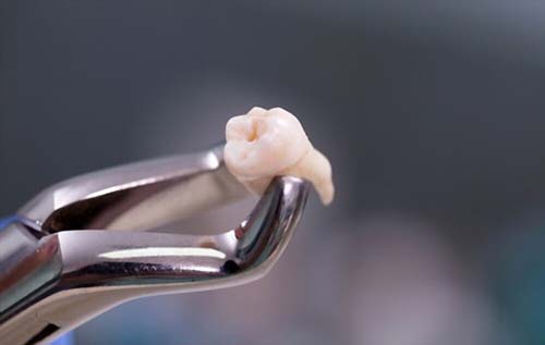 What are the Alternatives to a Root Canal