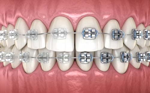 What do Braces Cost?
