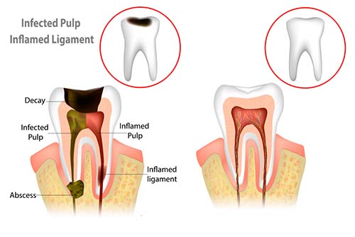 Abscess teeth