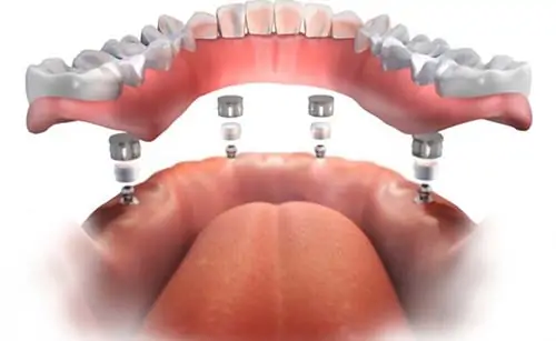 Denture Implants