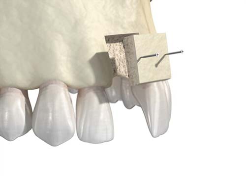 Different Types of Bone Grafts and How they Work
