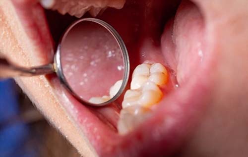 Temporary Fillings