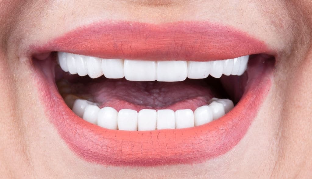 How Much Are Porcelain Veneers