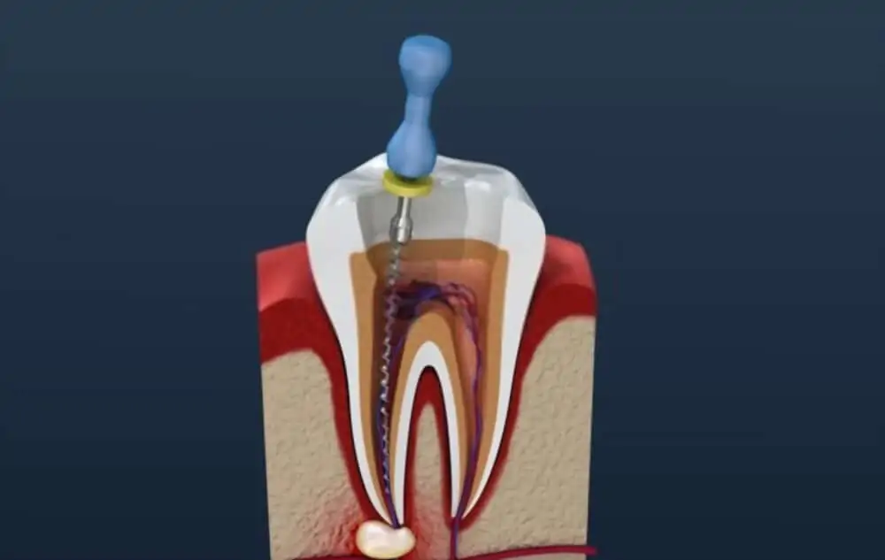 How Much Is A Root Canal