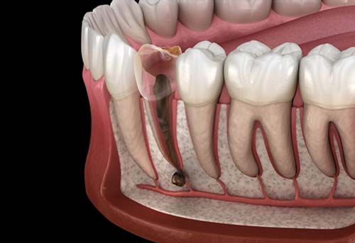When do you need a Root Canal? When do you need a Root Canal?