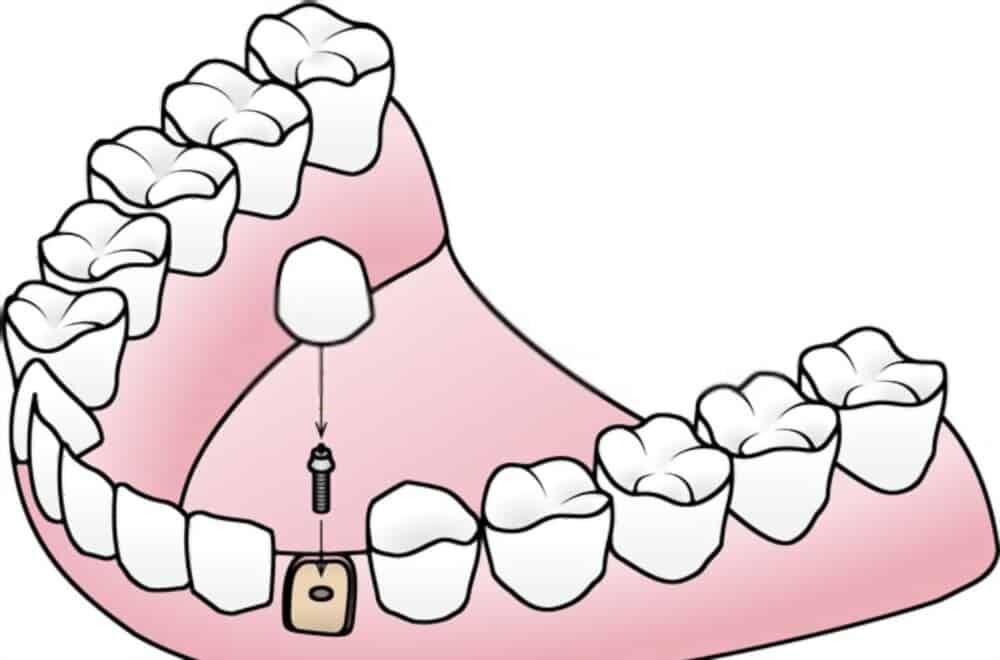 Endosteal dental implants
