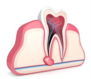 dental implants nerve damage