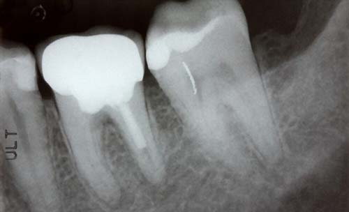 Do Root Canals Fail