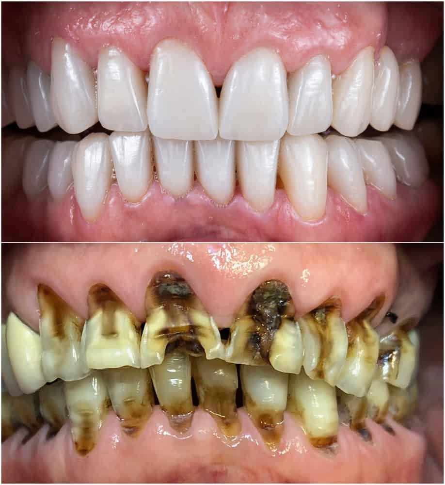 The Difference Between Veneers and crowns Ultimate Guide