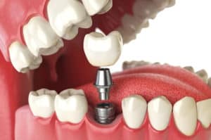 tooth implant in Turkey