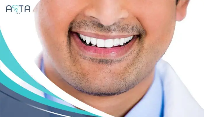 Cost Of Composite Veneers new 2024